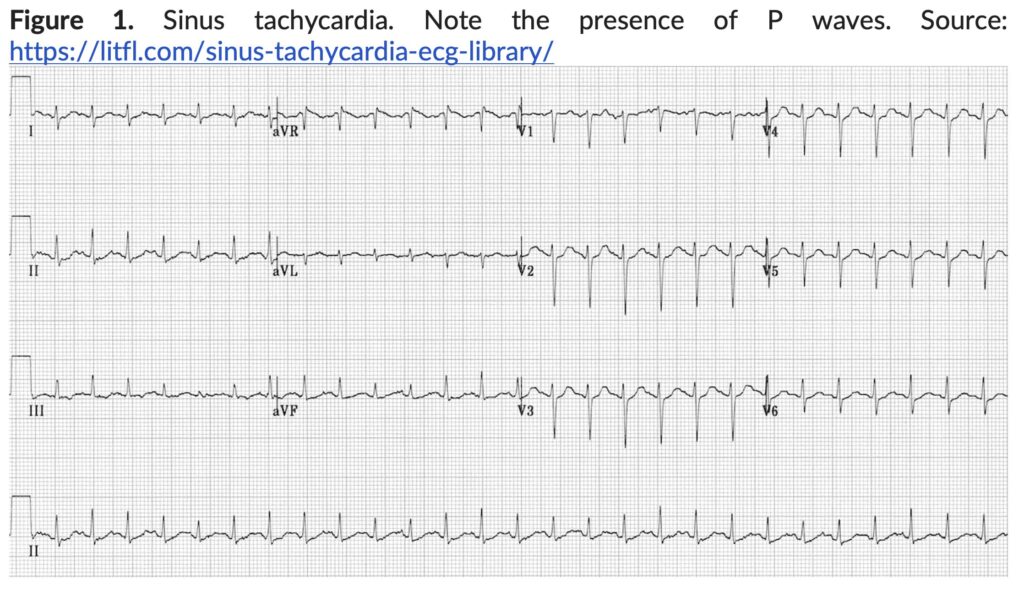 Figure 1. Sinus Tachycardia.